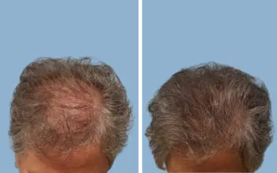 Before and After